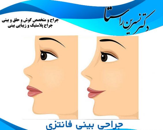 عمل بینی فانتزی